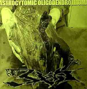 3XA - Astrocytomic Oligodendrollioma