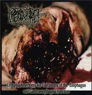 Hipermenorrea - Lymphadenectomy For Carcinoma Of The Esophagus And Gastroes ...