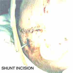 Shunt Incision - Shunt Incision