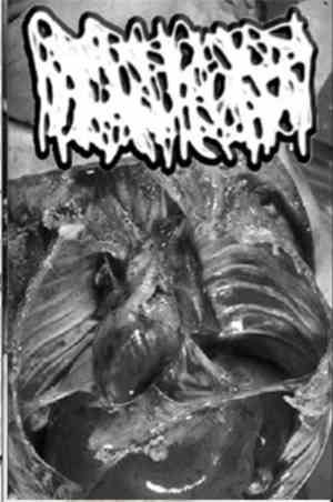 Hydrocephalus - Renal Multicystic Dysplasia